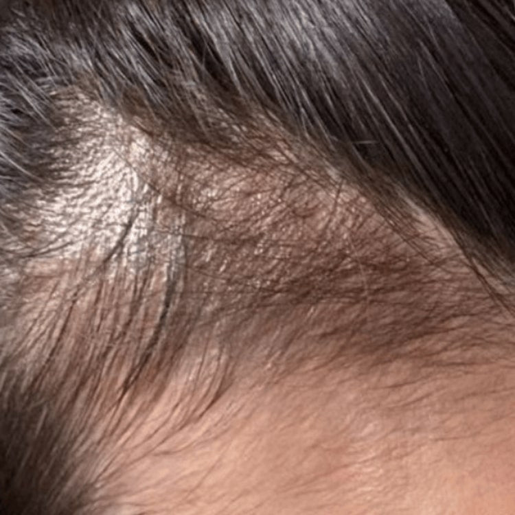 Additional scalp progress photo