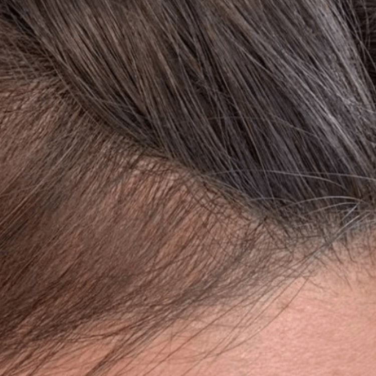 Additional scalp progress photo